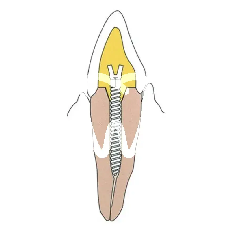 Screw post dore rst xlong nº6 ø 1,80 mm tenons et pivots dentatus